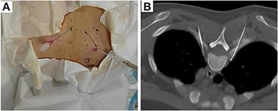 Efficacy and safety of sympathetic radiofrequency thermocoagulation in the treatment of cold hypersensitivity